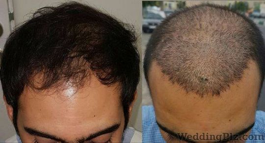 Athena Hair Now Hair Transplant Slimming Beauty and Cosmetology Clinic weddingplz
