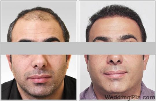 Athena Hair Now Hair Transplant Slimming Beauty and Cosmetology Clinic weddingplz